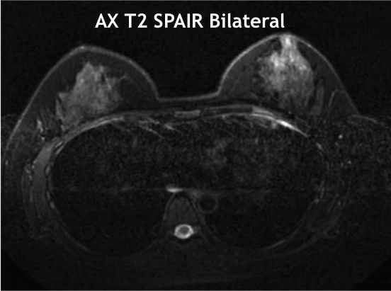 MR Bilateral Breasts WWO Protocol | OHSU